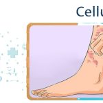 Cellulitis 1
