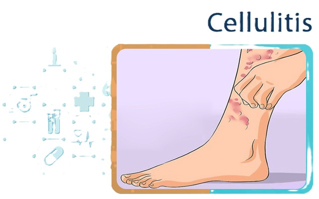 সেলুলাইটিস (সেলুলাইটিস) কী? কেন হয়, চিকিৎসা ও প্রতিরোধ । 1 Cellulitis 1