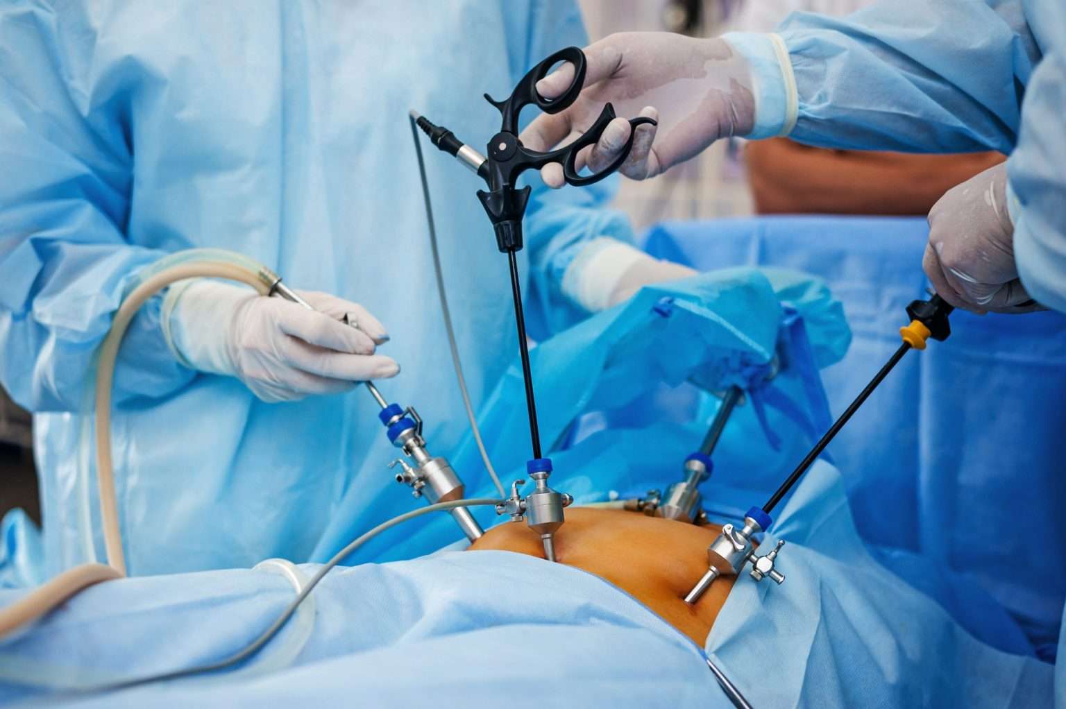 Laparoscopy-1536×1022-1
